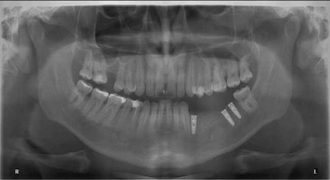 pacient cu implant dentar